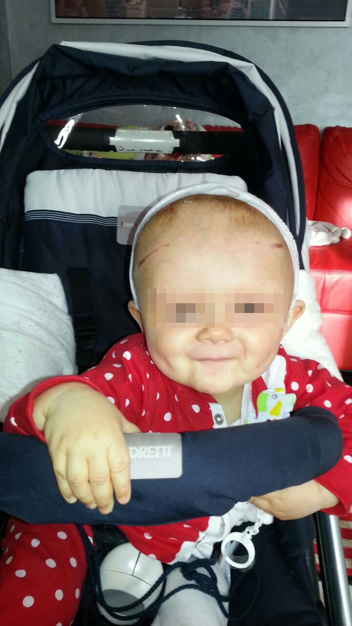 Il piccolo paziente è tornato a casa! Craniostenosi, bimbo dopo intervento