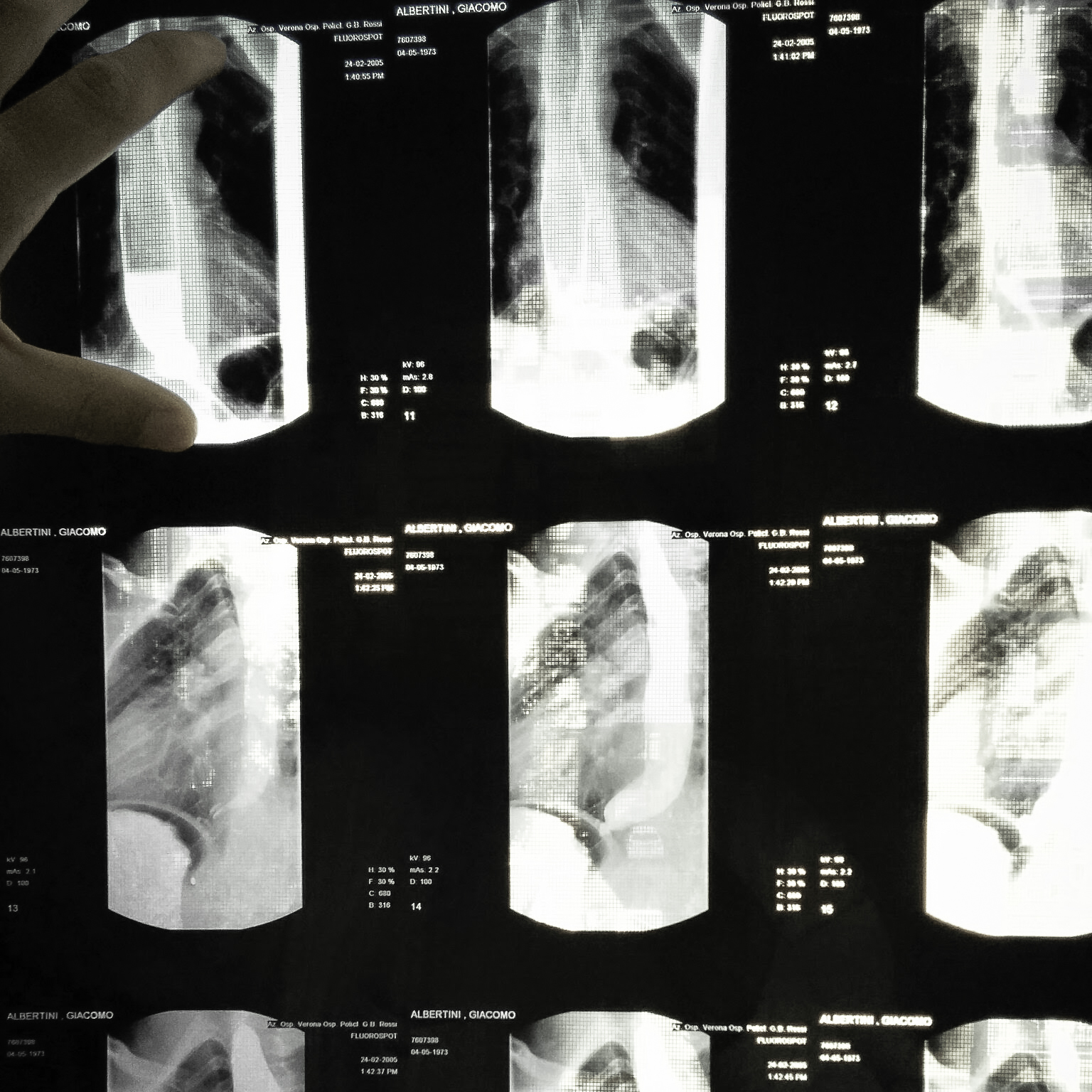 Parliamo di acalasia esofagea di ALMA ONLUS Parliamo di acalasia esofagea-ALMA ONLUS