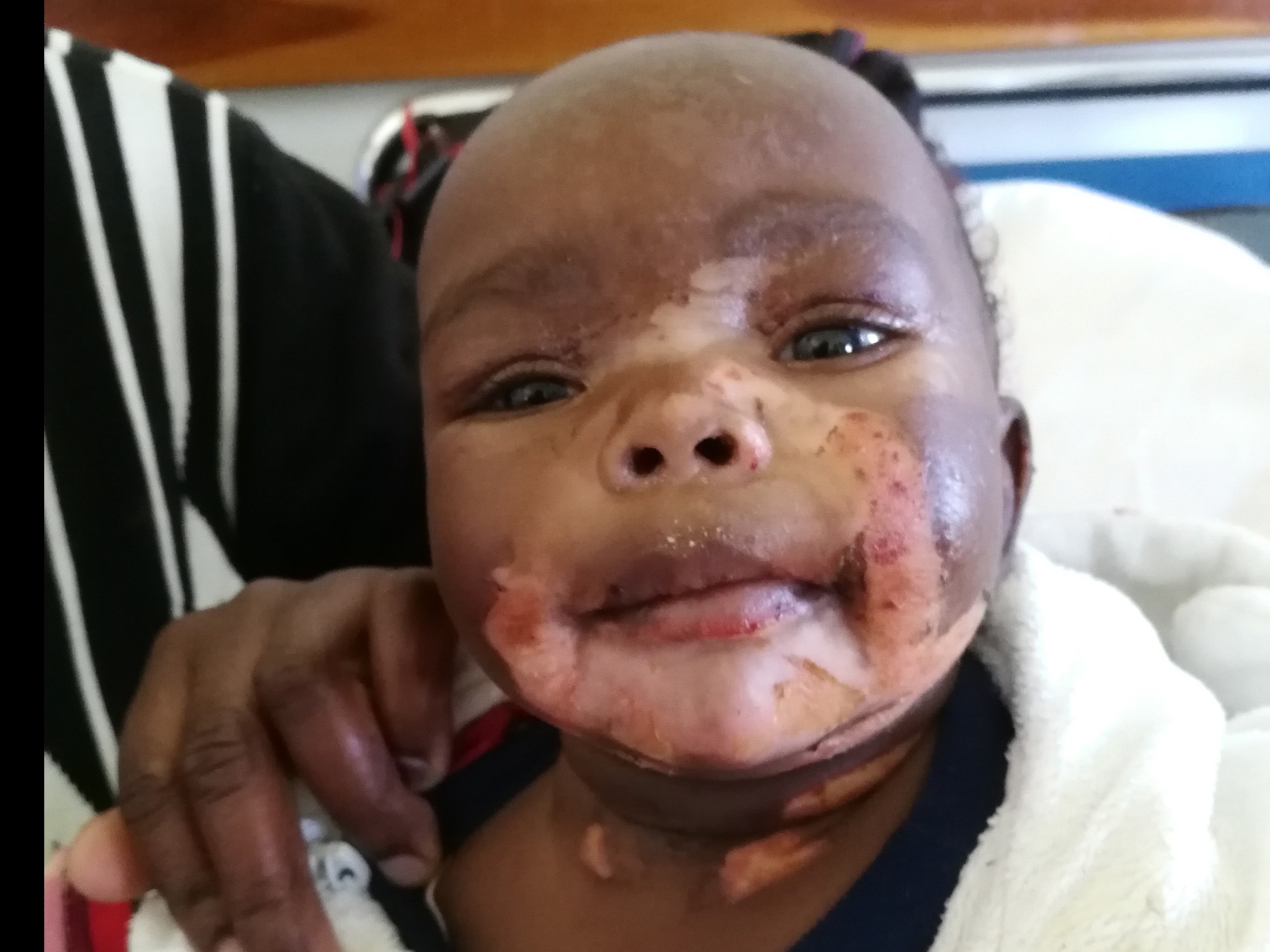 "Dona un sorriso ai bambini ustionati" di HFL "Dona un sorriso ai bambini ustionati"-HFL